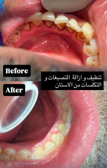 شلون حتشوفني بعيادة هملايا اذا تزورني كل
٦ اشهر كل سنة و كل سنتين و كل 4 سنين 

✨ ابتسامتك… أمانة بين أيدينا ✨
في عيادة د. (مهند السعدي) نعتني بكل تفصيلة في أسنانك، من أبسط ألم إلى أجمل ابتسامة.
✔️ حشوات تجميلية عالية الدقة
✔️ تبييض آمن بنتائج فورية
✔️ علاج عصب بأحدث الأجهزة
✔️ ابتسامة هوليود بدون مبالغة
✔️ متابعة ناعمة للأطفال
مكان واحد يجمع الراحة – التعقيم – الدقة – والنتيجة الذهبية…
نسعد بزيارتكم يومياً من الساعة 2 ظهراً و إلى ٩ ليلاً

📍 العنوان: حي المهندسين / شارع الخيمة / فوق اسواق كوب
📞 لحجز المواعيد :***********
