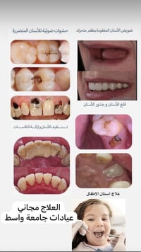 مجانا • حشوات جذر • كلية طب الاسنان