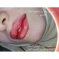 عرض التجميل لفترة محدودة فلر اسباني الابرة الواحدة ب 50 الف (تفتح العل...
