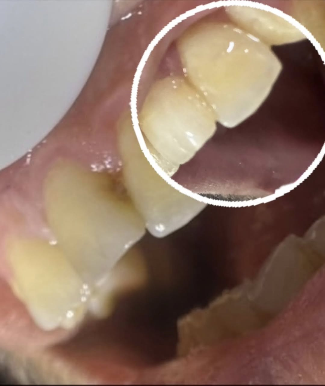 ✨ علاج أسنان مجانًا وبإشراف أطباء اختصاص ✨
السلام عليكم 
• حشوات ضوئية للأسنان الأمامية والخلفية
 • قلع الأسنان المتحركة والتالفة
 • تنظيف وتلميع الأسنان
 • تعويضات جزئية متحركة
 • كل الشغل يتم بإشراف دكاترة اختصاص من الجامعة لضمان أفضل نتيجة

📍 الموقع: جامعة أوروك – كلية طب الأسنان – شارع 52 / الكرادة
📅 المواعيد: يوم الأحد والاثنين
😊 خلي ابتسامتك ترجع بثقة

📞 للتواصل: ***********
