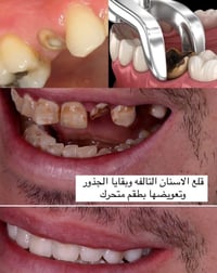 علاج اسنان مجاني • كلية طب اسنان • كرادة شارع 52