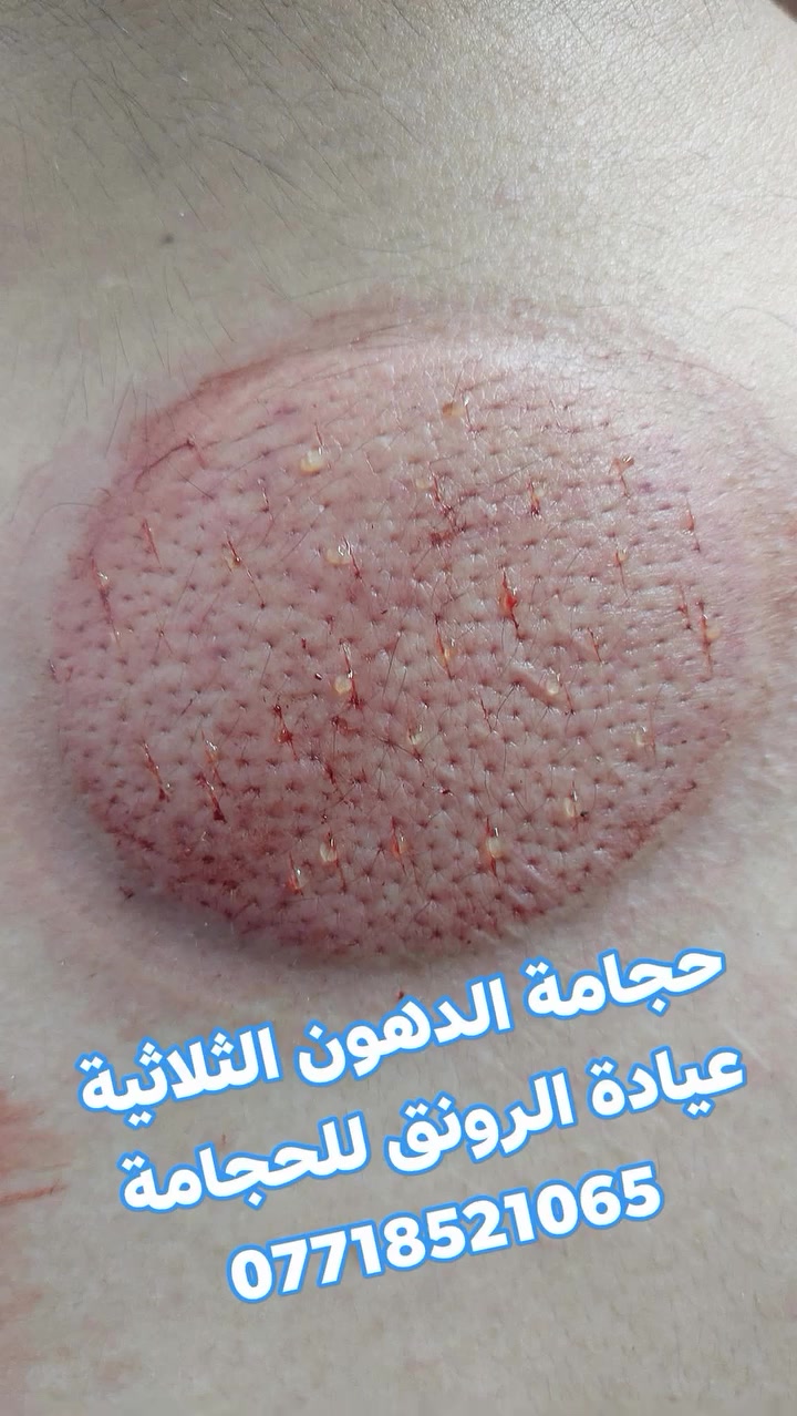 #بعض أعمالنا في العيادة 🩸🩸🔥🔥
#عيادة_الرونق_للحجامة*********** 

١. #حجامة الوقاية العامة الشاملة 
٢.#حجامة لعلاج الألم الرأس والرقبة والسمع والنطق
٣.#حجامة لعلاج الألم القدم والساق والكعب والركبة
٤.#حجامة لعلاج القالون والمعدة والامعاء 
٥.#حجامة لعلاج الضعف الجسدي 
٦.#حجامة لعلاج الجلطة الدماغية الشلل النصفي
٧.#حجامة لعلاج الانزلاق والسوفان 
٨.#حجامة الرياضية لأهل كرة القدم 
٩.#حجامة لعلاج القصبات واجيوب الأنفية 
١٠.#حجامة لعلاج الألم اسفل الظهر 
١١.#حجامة لعلاج خدر الاقدام والساقين 
١٢. #حجامة أماكن عملها الرسول عليه الصلاة والسلام

#ملاحظة الأدوات تستخدم مره واحده فقط 

‏‎#قال النبي ﷺ : "إنَّ أَفْضَلَ ما تَدَاوَيْتُمْ به الحِجَامَةُ، أَوْ هو مِن أَمْثَلِ دَوَائِكُمْ".
 
#متواجدين طوال ايام الاسبوع  صباحا ومساءا  ..
#العنوان المقدادية حي العصري قرب المذخر  مساءا
#الفرع الثاني المقدادية الهارونية مجاور المحطة صباحا 

#اي استفسار *********** حياكم الله 🌹

