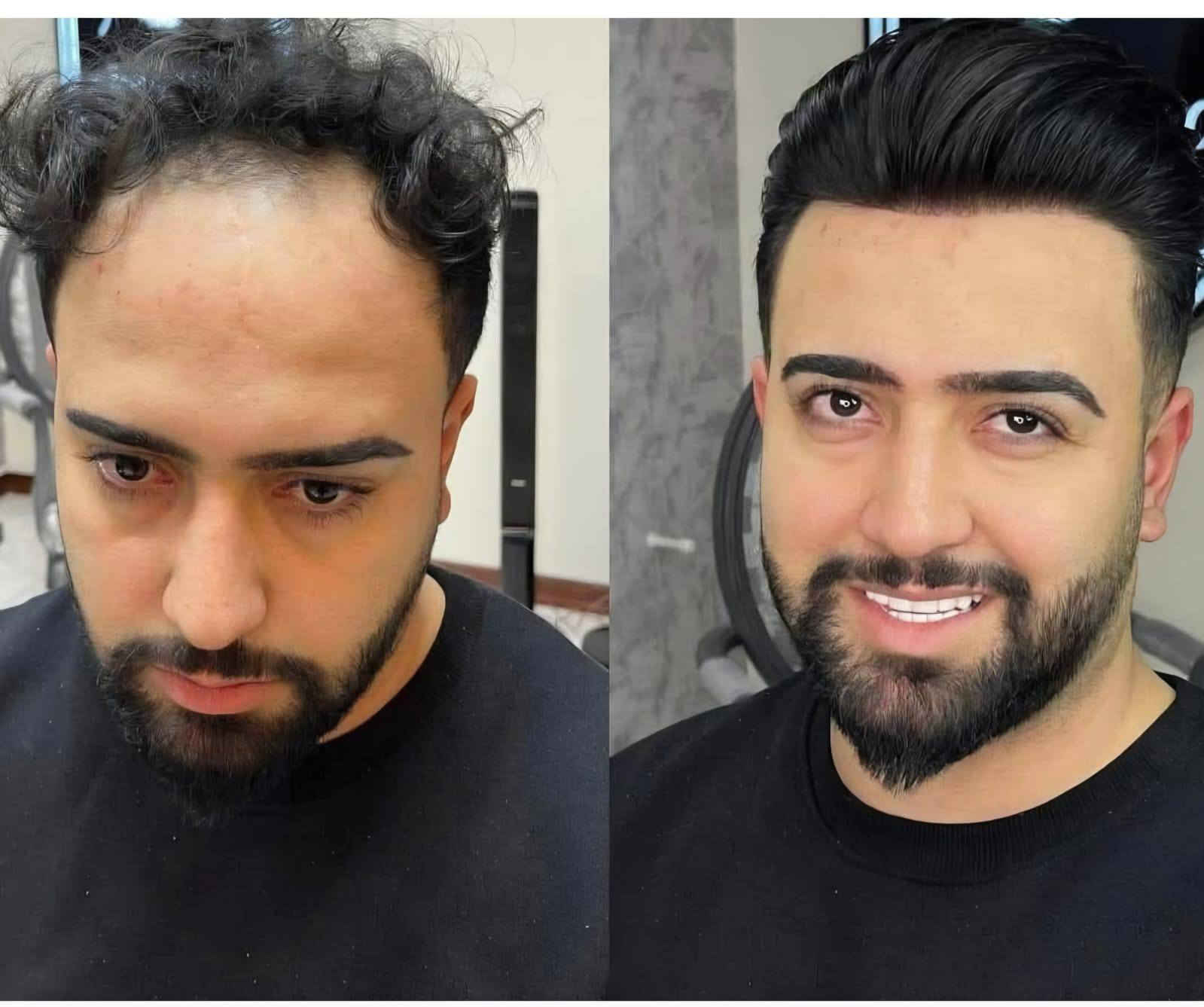 💥احدث تقنيات زراعة الشعر بعيادة بغداد .
💥بأدرة دكتور يونس البديري .

💥زراعة vib كامل التفاصيل علينه.

//للتواصل (***********)واتساب وتصال
