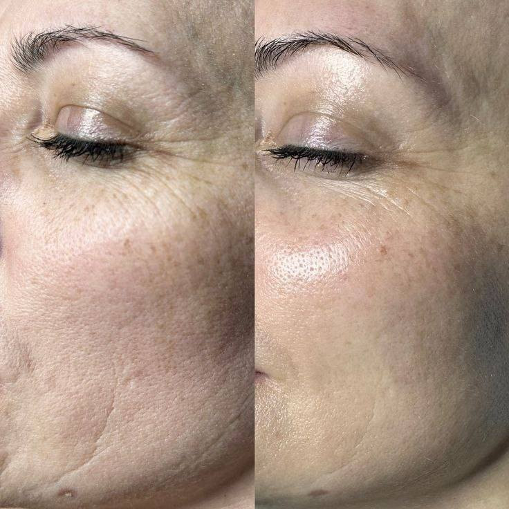 عمايل الريتينول
ازالة التجاعيد والخطوط الرفيعة
متوفر توصيل لجميع محافظات العراق

#اكسبلور #لايك #فولو #فولومي #فولورز


**إذا كنت صاحب هذا الإعلان وتريد حذفه لأي سبب، رجاءا أرسل رسالة إلى الدعم الفني**