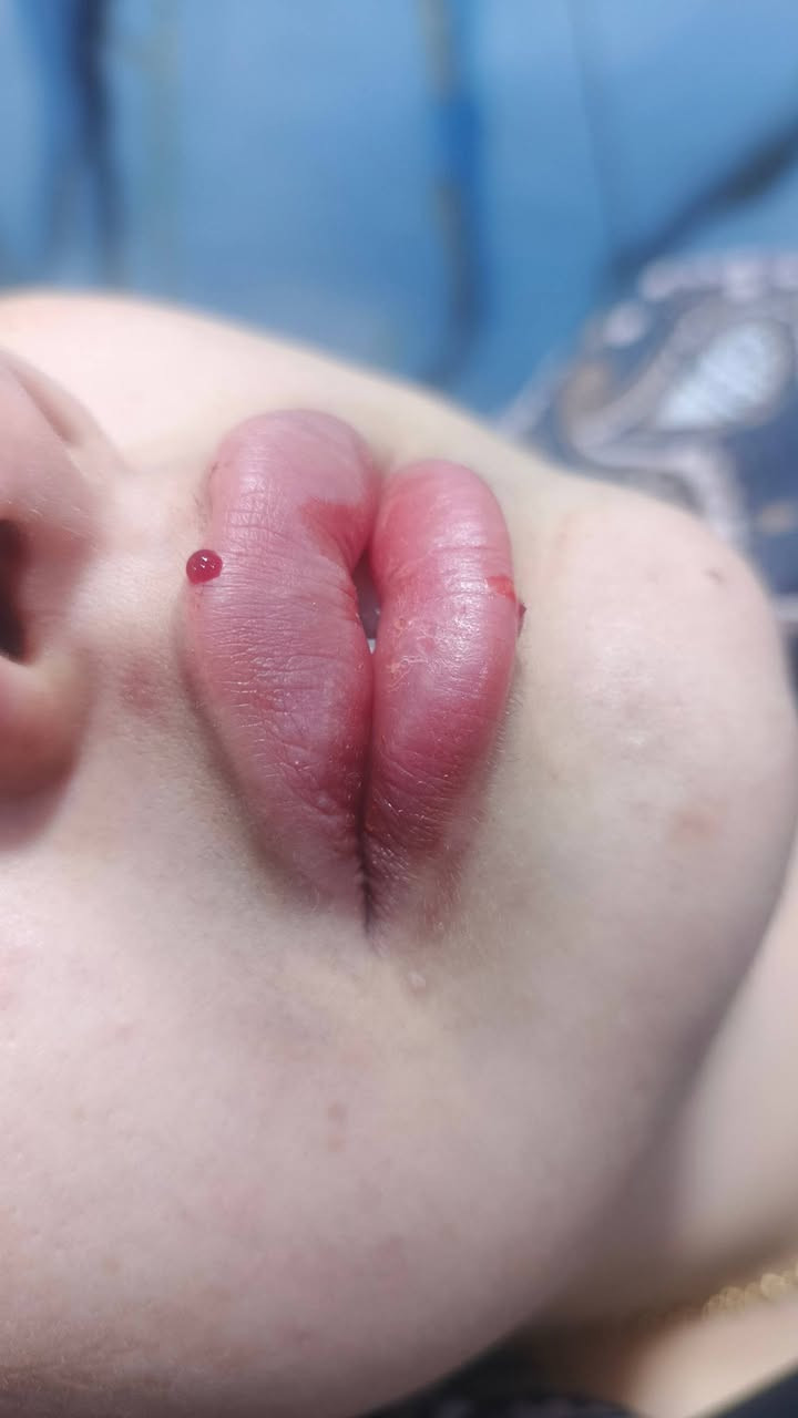 هلاو  بنات  عرض  العيد
فلر  شفه  الكوري ٣٠
 فلر  شفه  السويسري  ٤٠ 
فلر  شفه  الانكليزي  ٤٥ 
فلر  شفه  الايطالي  ٥٠
............. فلر الوجنات ........... 
فلر االخدود  الكوري  ٢٠  سي  الواحد 
فلر  الخدود  السويسري ٣٠ سي الواحد 
فلر  الخدود  الانكليزي  ٣٥  س الواحد 
فلر  خدود اليطالي ٤٠  س  واحد 
كل  اثنين  اخوات  او  صديقات  تاخذون  سيسي  مجاني  
..................... ابرةالنظاره ...... 
عرض  ابرة  الرتفال  ٢٥  
ابرة  العنبر  + ابلازمه  ٣٠ 
ابرة  طماطه  +  تنضيف  بشره  عميق  ٢٥ 
 ابرة  العروس  +  الفيتامين  سي  ٢٥ 
 ........................مكس  الايطالي  الخاص بدكتورا  ٥٠ الف  
تنضيف بشره  عميق هديه  
كل  اثنين  صديقات  او اخوات  الهم  هديه بختيارهم  من  داخل  صالون  
 ........ تغير شامل  الفلر  كوري  ١٠
يشمل  الخدود 
تكساس  
ذقن  
اصداع  
شفه  
150الف  
............. تغير شامل  الفلر  الاسويسري  ....... 
الخدود  
تكساس  
ابرزاز  ذقن  
اصداع  
شفه 
........... 200الف  +  اابرة الفيتامين سي هديه 
 ....... تغير شامل  الفلر  الايطالي  ....... 
الخدود 
تكساس  
ابراز  ذقن  
اصداع  
شفه 
250الف   +  ابرة العنبر  +بوتوكس  سحب  الحاجب


**إذا كنت صاحب هذا الإعلان وتريد حذفه لأي سبب، رجاءا أرسل رسالة إلى الدعم الفني**