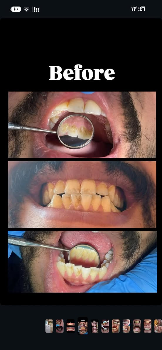 🦷 علاج أسنان مجاني 100%! لفترة محدودة ⏳

#حشوات تجميلية بجلسة واحدة  
#تنظيف اسنان | #قلع الاسنان والجذور التالفه | #تقويم اسنان   
#تعويض أسنان (فك كامل أو فكين)  
علاج مشاكل أسنان #الأطفال بالكامل👶  

👩‍⚕️ بإشراف أطباء اختصاص  ✨ أجهزة وتقنيات حديثة  

📍 #شارع 40 – مجاور صيدلية سلامتك أولاً  

📲 واتساب: ***********  

📸 الصور نماذج من شغلنا
