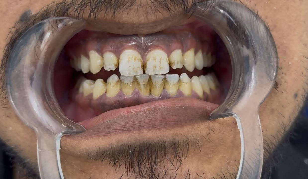 تنظيف الأسنان بجلسه واحدة فقط 
متواجدين يومياً قبل وبعد الأفطار 

عيادة الضامن لطب وتجميل الاسنان 
قرب فلكة الصدرين مجاور صيدلية علي هاشم الموسوي
رقم الحجز ***********
