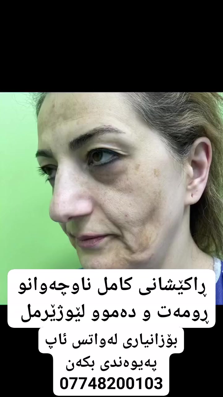 تکایە فۆڵۆی پەیج لەبیر مەکەن .
سەنتەری دکتۆرئەمیر ڕەزا درەخشان لە شاری مەریوان بۆ هەموو کارێکی جوانکاری بەباشترین ستافی شارەزاو بە هەرزانترین  نرخ بۆ زانیاری ئەتوانن پەیوەندی بکەن بەم ژمارە تەلەفونەوە یان لە واتس ئاپ یان ڤایبەر 
*********** 
 #سلێمانی _دووکان_قەرەداخ_ڕانیە_قەڵادێ_دەربەندیخان_سەیدسادق_چوارتا_چەمچەماڵ_کەلار_کفری_ماوەت_شارباژێڕ😘ranya_😍soran_❤️kelar_🌸 #هەولێر #کەرکوک #هەڵەبجە #دهۆک
