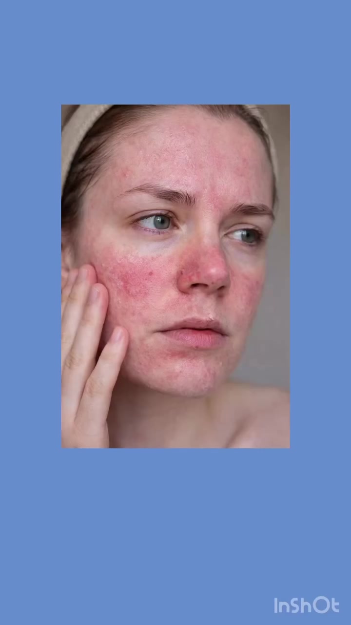 ‏ La Roche-Posay Cicaplast Baume B5+ 💙
البلسم المعالج اللي يشتغل بسرعة على ترميم البشرة ويرجعها ناعمة وهادية!

🌿 شنو يميزه؟
 • يعالج الجفاف والتشققات بسرعة
 • يهدّي الاحمرار والتهيج فوراً
 • مناسب للبشرة الحساسة وحتى بعد الليزر أو التقشير
 • بيه فيتامين B5 حتى يساعد على ترميم البشرة
 • خفيف وما يسد المسام

💧 من أول استخدام راح تحسين الفرق… بشرة أنعم، أهدأ، وصحية أكثر

✨ مناسب للوجه والجسم وحتى للأطفال

💊 صيدلية القمة البيضاء 💊
نهتم بصحتكم وجمالكم بكل التفاصيل 🌿

📍 العنوان:
بسماية – الشارع العام
مجاور فاملي ماركت وأمير أمزون
بالقرب من كولدن هوم

📞 للتواصل:
دايركت 💬 أو على الرقم: ***********

🚚 يوجد توصيل لكل المحافظات
