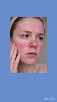 Cicaplast B5 • مرمم بشرة • بشرة حساسة