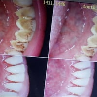حشوات تجميلية • طب الأسنان • شارع 60