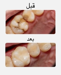 النجف • تنظيف اسنان • حشوات تجميلية