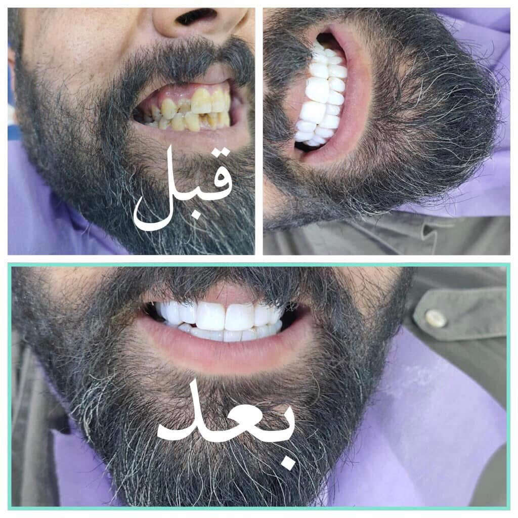 السلام عليكم ورحمة الله وبركاته
الى اهلنا وناسنه الي ساكنين قرب جزيرة بغداد السياحية والمناطق المجاوره 

توفر لكم عيادة الدكتوره ايلاف عبدالوهاب صادق اخصائيه في جراحة الفم والاسنان وسيرتفكت في مجال التجميل وحشوات الجذور وقلع الاسنان وتركيب الاسنان الثابته

نوفر لكم عروض لمدة اسبوع 

تنظيف وتبيض الأسنان ب5 فقط 

كشفيه مجاناً

حقن بلازما للشعر والبشره ب5 فقط ايضا لمدة اسبوع 

توجد عروض اخرى على حقن البوتوكس والفلر اسعار مناسبه ومواد أصليه 

العنوان بغداد شارع جزيرة بغداد السياحيه 

تعبر الباب الاول تجيك الفلكه اول متعبر الفلكه اول فرع عليمين عمارة مكتب الفياض للعقار احنه بداخل القيصريه

للاستفسار ***********

