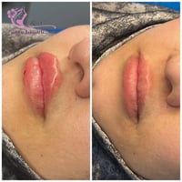 فيلر شفة • مجمع علم الكندي • إزالة تاتو