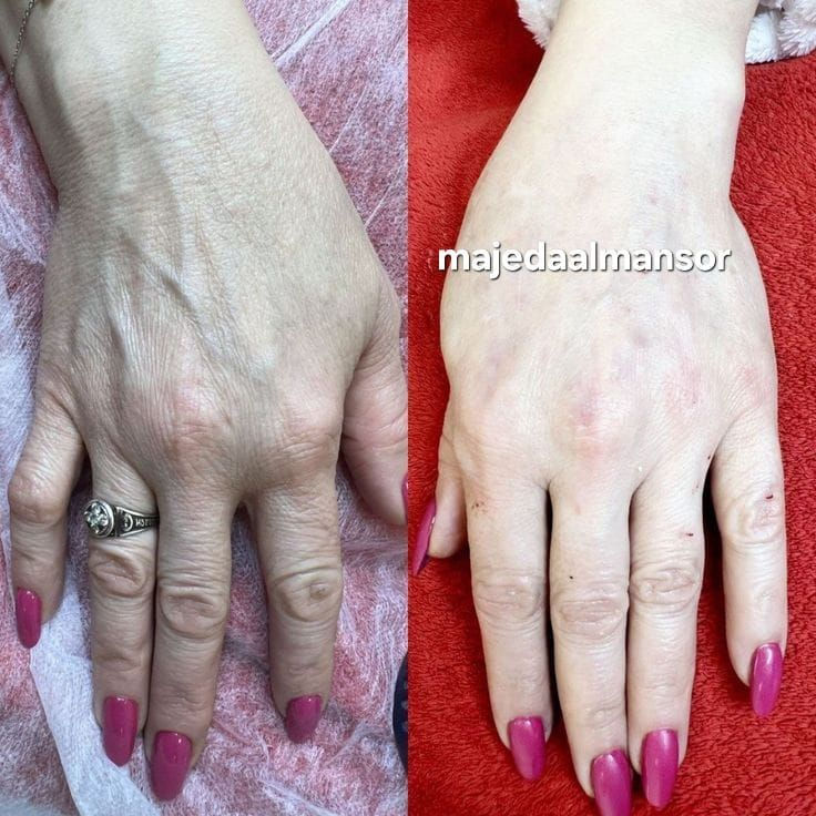 اجمل رسماة  الشفاه 
ازالة التجاعيد شد وامتلاء الوجه 
ازالة تجاعيد اليد 
مواد أمنة واصلية 
الدكتورة  ماجدة المنصور Jojo Alnabeel 
العنوان بغداد الحسينية مقابل السوق الكبير مجاور مرطبات العذراء
مجمع سما الحسينيه الطابق الثاني قسم التجميل والصالون ***********
