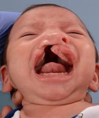 قضاء الفهود • شفة الأرنب • عمليات مجانية