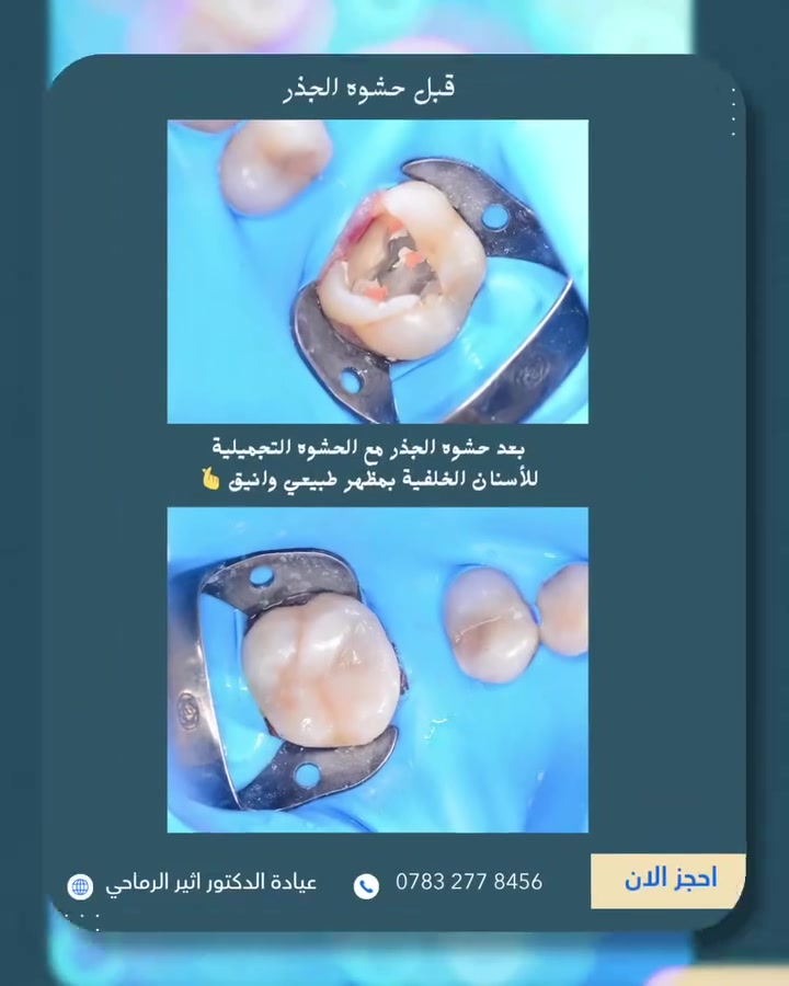 “تم إجراء حشوة جذر وتجميلية بعناية دقيقة لاستعادة الراحة والمظهر الطبيعي للأسنان.”

             (عيادة الدكتور أثير حليم الرماحي) 

☎️ للحجز والاستفسار ***********
او مراسلة الصفحة

📍 الموقع: 
[الديوانية-قضاء عفك/شارع الأطباء قرب صيدلية أكرم 
البديري-بناية الدكتورة مروة حمود التميمي-الطابق الثاني]

#ابتسامتك_تستحق_الأفضل #دكتور_أسنان
#حشوات_جذور_الاسنان #حشوات_تجميلية
#الديوانيه_قضاء_عفك #حشوات_تجميليه_حشوات_جذر_قلع_جراحي_تركيب
