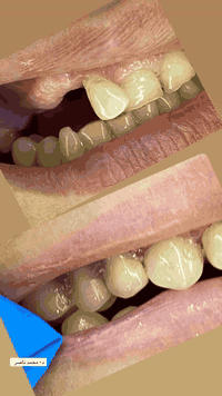 📌تعويض الأسنان المفقوده بعمل تركيب اسنان المرنه رجعنا الاسنان بعد ماكانت تعاني مراجعتنا من الم وفقدان للأسنان 🦷🔥🙏
د- محمد ناصر 
للحجز واتساب ***********
