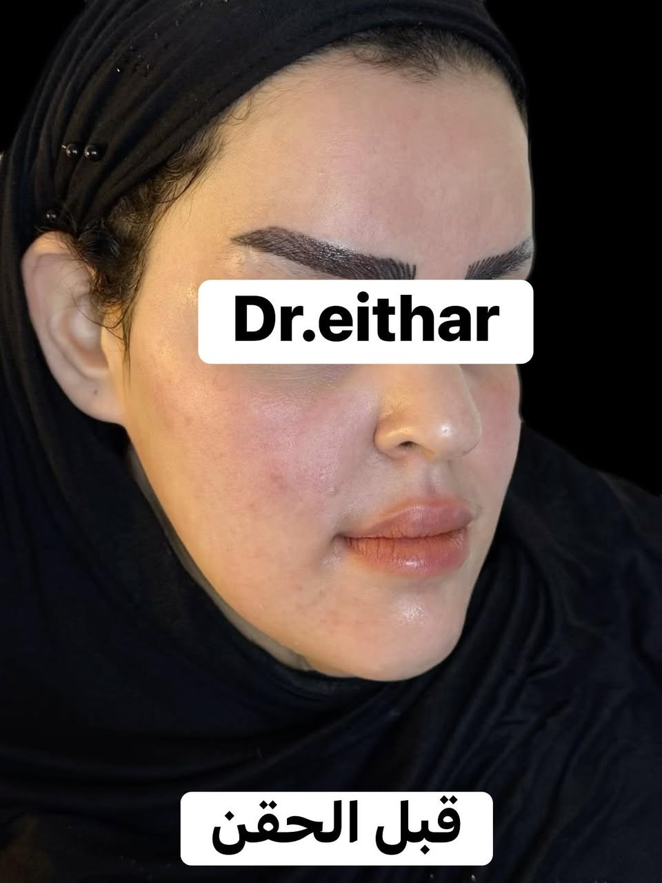 إلتغيير  والشد والشفة ولاغلطة 🔥🔥🔥
استداره وجه كامله بطريقه الشد ولفتتك 🔥رفع وجنات والاصداغ وتدوير الفك والذقن والخسفات ✨وفلر  الشفة 
د.ايثار سامي عبد الامير
الكوت الهوره مجمع القبطان طابق اول قرب كوزمتك احمد باريس
الحجز***********
