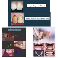 علاج مجاني • حشوات ضوئية • عيادات ابن سينا