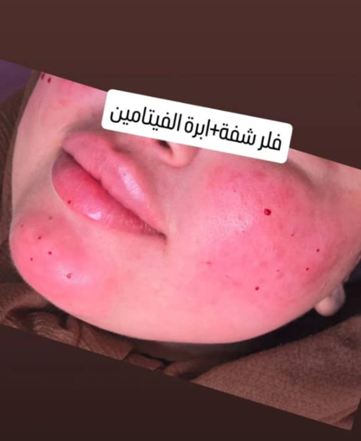 سلام عليكم دكتوره ايرانيه ابو رمانه اسعارهه مناسبه رجال ونساء تشتغل جراحه همين ابو رمانه ***********
