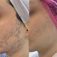 ليزر ازاله شعر الوجه بجهاز كانديلا العبيدي بنايه المجلس البلدي القديم ...