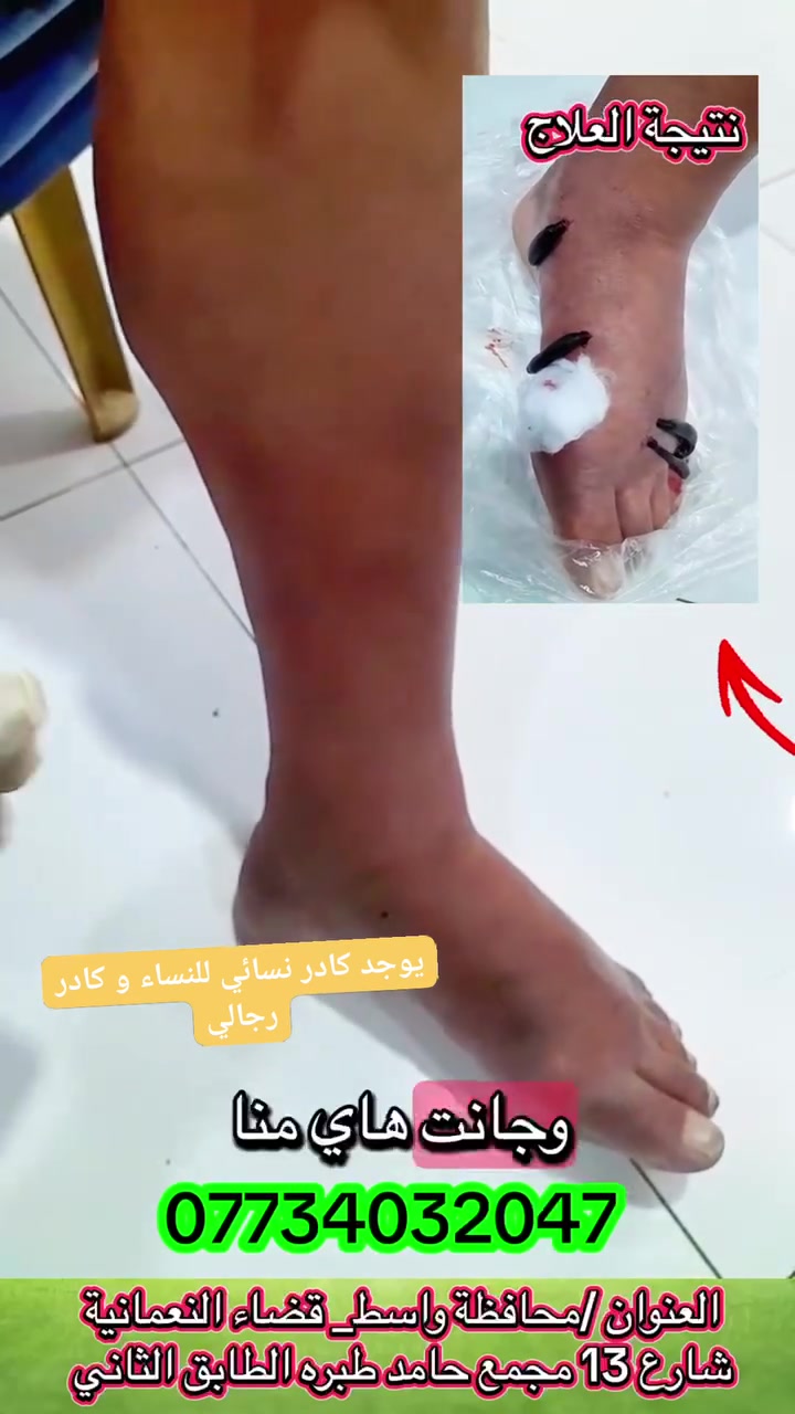 الحجامه النسائية والطب البديل 
 المصطفى للحجامة و الطب البديل 
🩸 فوائد معالجة تخثر الدم بالعلق الطبي:
▪️ يساعد على تنشيط الدورة الدموية وتحسين جريان الدم
▪️ يخفف من حالات التخثر والتجمعات الدموية
▪️ يقلل الالتهاب والاحتقان في المناطق المصابة
▪️ يساعد على إيصال الأوكسجين للأنسجة بشكل أفضل
▪️ يخفف الألم والتشنجات العضلية
▪️ يُستخدم ضمن الطب البديل بإشراف مختص للحالات المناسبة
العلاج بالعلق الطبي من الطرق القديمة المعروفة، ويحتوي لعاب العلق على مواد تساعد على سيولة الدم وتحسين التروية الدموية. 🌿
#العلق_الطبي
#تخثر_الدم
#الطب_البديل
#الحجامة
#العلاج_الطبيعي
#تنشيط_الدورة_الدموية
#علاج_التخثر
#الصحة
#علاج_بالعلق
#ابو_علي_للطب_البديل
 #الجميع 
 #متابعين 
 #اشارة 
 #الكل
 @إشارة


**إذا كنت صاحب هذا الإعلان وتريد حذفه لأي سبب، رجاءا أرسل رسالة إلى الدعم الفني**