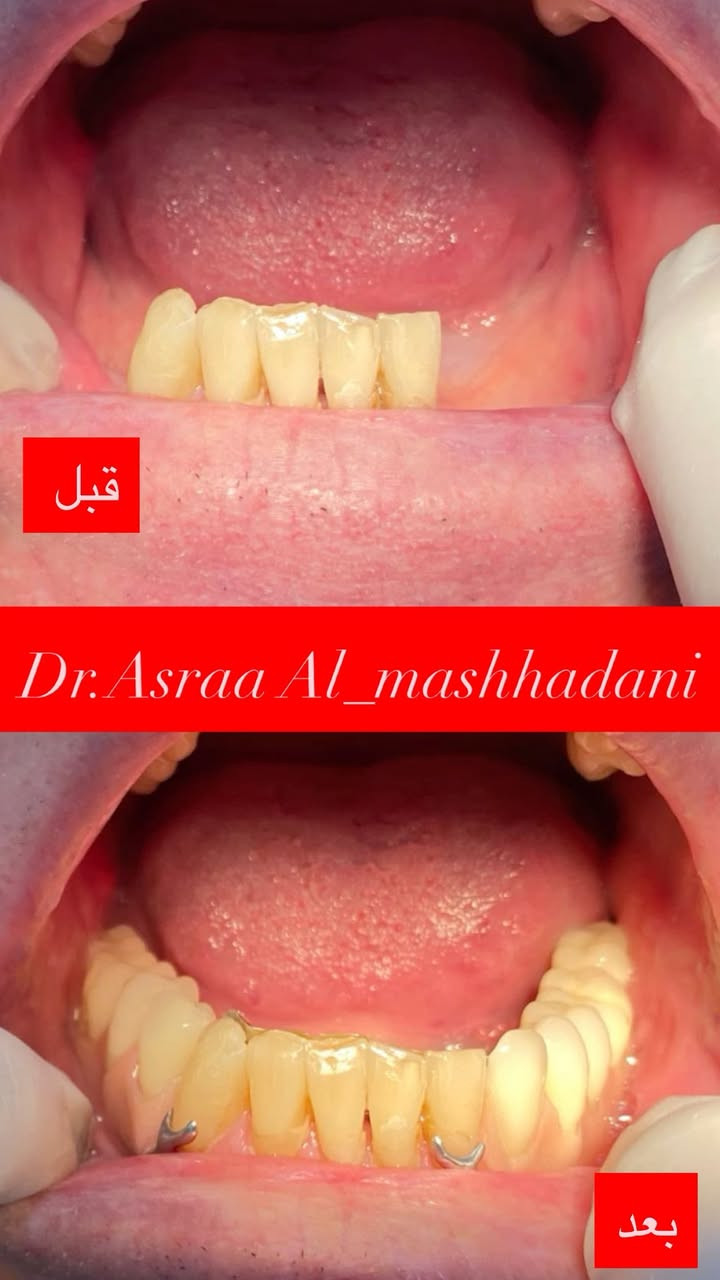 السلام عليكم اللي عدهم فقدان بأسنانهم كما هو موضح بالصور ادناه ⬇️ الحل صار موجود بطقم كامل للاسنان  وصار (العلاج مجاناً) ولا نحتاج فقط الدعاء منكم متواجدين يوميا عدا يوم الخميس في (عيادات كلية الرشيد ) بغداد_ حي الحسين مقابل محطة وقود حي العامل

اللي يحب يستفسر يتواصل وياية حتى نرتب مواعيدكم إن شـاء الـلّٰـه (***********)
