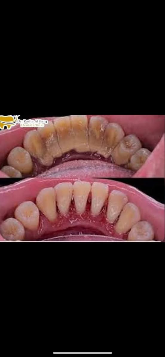 اهالي الحلة
الي عنده تكلسات هيج بأسنانه
(نشتغل تنظيف الاسنان من التكلسات مع تبييض الاسنان)
يتواصل وياي بالخاص
او على هذا رقم الواتساب:***********
علماً العمل مجاني
عنوان العيادات 
عيادات جامعة الحلة_شارع اربعين _مجاور صيدلية سلامتك
