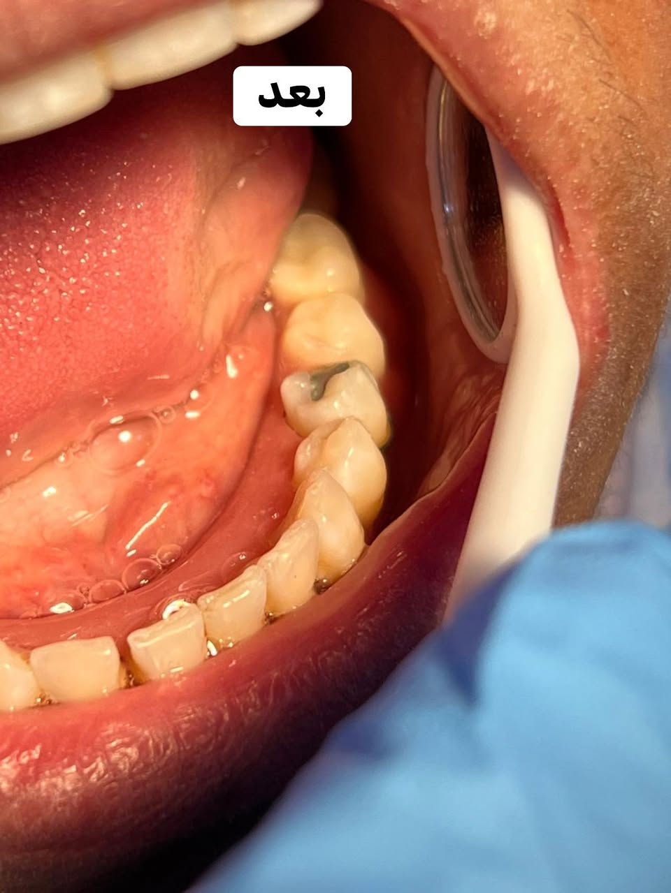 السلام عليكم 
رجعت انفتحت الحجوزات عند الدكتورة تبارك المشعان 
لتعويض الاسنان المفقوده وبشكل مجاني 100‎%‎ 
وكذلك الحشوات وقلع الاسنان التآلفه وتعويضها 
علقو تم او راسلوني خاص على الماسنجر او على الرقم التالي *********** على الواتساب
علماً الحجز ينغلق يوم الجمعة مساءاً
