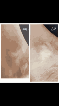 جهاز الاكزايمر لعلاج البهاق والصدفية والثعلبة ♥️♥️
متوفر حصريا يمنا ✌️
العزيزية /شارع الخليج المجمع الطبي العالمي
رقم الحجز ***********
