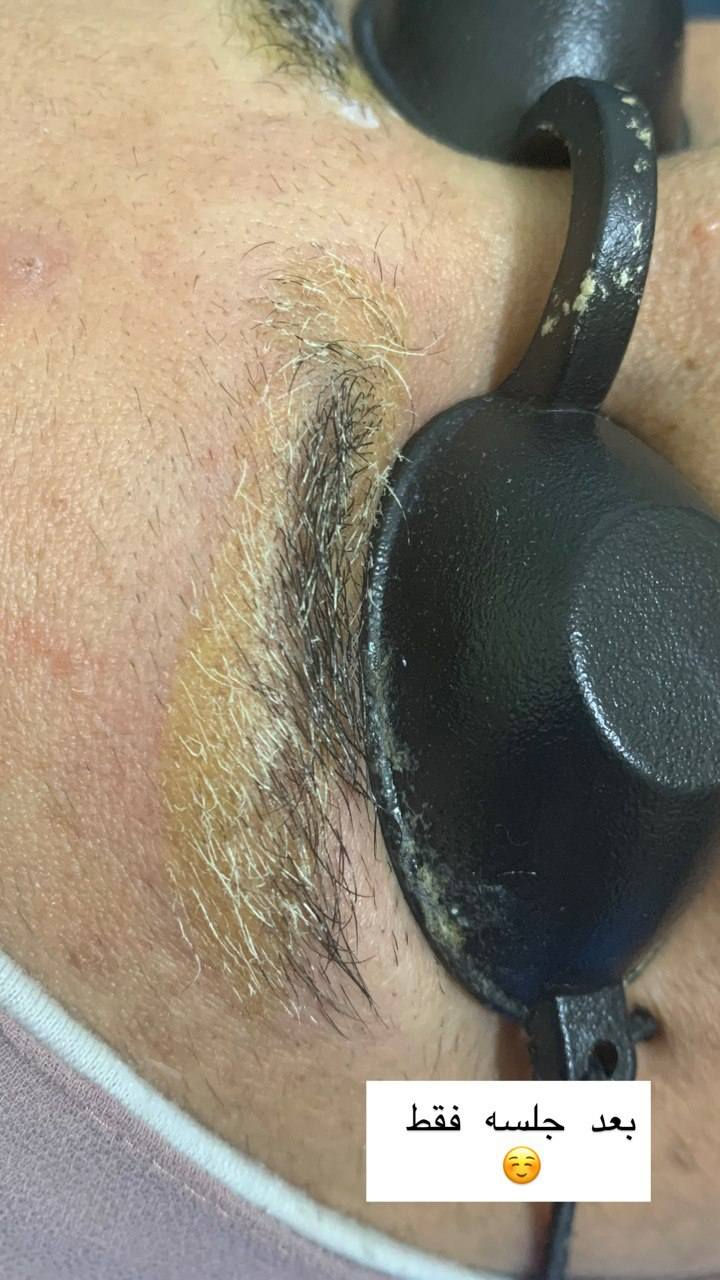 #عيادة فلورا للتجميل والليزر والاسنان 

#جلسه إزالة التاتو ❤

 #العنوان؛ طوز _ سوك الجمهوريه  _ مجاور ملبوسات مختار 
طابق تأني لجامعة 
الرقم؛ ***********📞

#علما_ليس_لدينا_فرع_اخر 🧿
