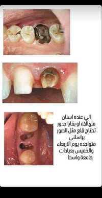 قلع اسنان • جذور متبقيه • جامعة واسط