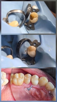 حشوه جذر مع بناء السن بالحشوات الضوئيه عياده الاسكندريه لطب وتجميل الا...