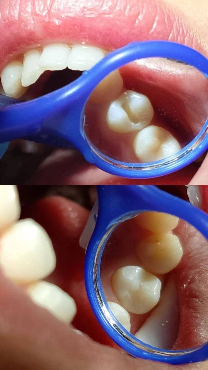 حشوه ضوئية تجميليه بجلسه واحده 🦷
عياده الاسكندريه لطب وتجميل الاسنان  
العنوان/ الاسكندريه ، خلف دائره الكهرباء ( مجمع الدكتور خالد عبد الخضر).
للحجز والاستفسار مراسله صفحه العياده او الاتصال على الرقم: 
***********
متواجدين يوميا من ٣ عصرا إلى ٩ باليل 

انستا العياده
 https://www.instagram.com/alexandria_clinic88?igsh=cjNtdWlmdWR1ODVu
الفيس 
https://www.facebook.com/share/1D2WrWPzQc/
