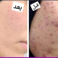 خلطة تبيض • وجه وجسم • نتايج بيومين