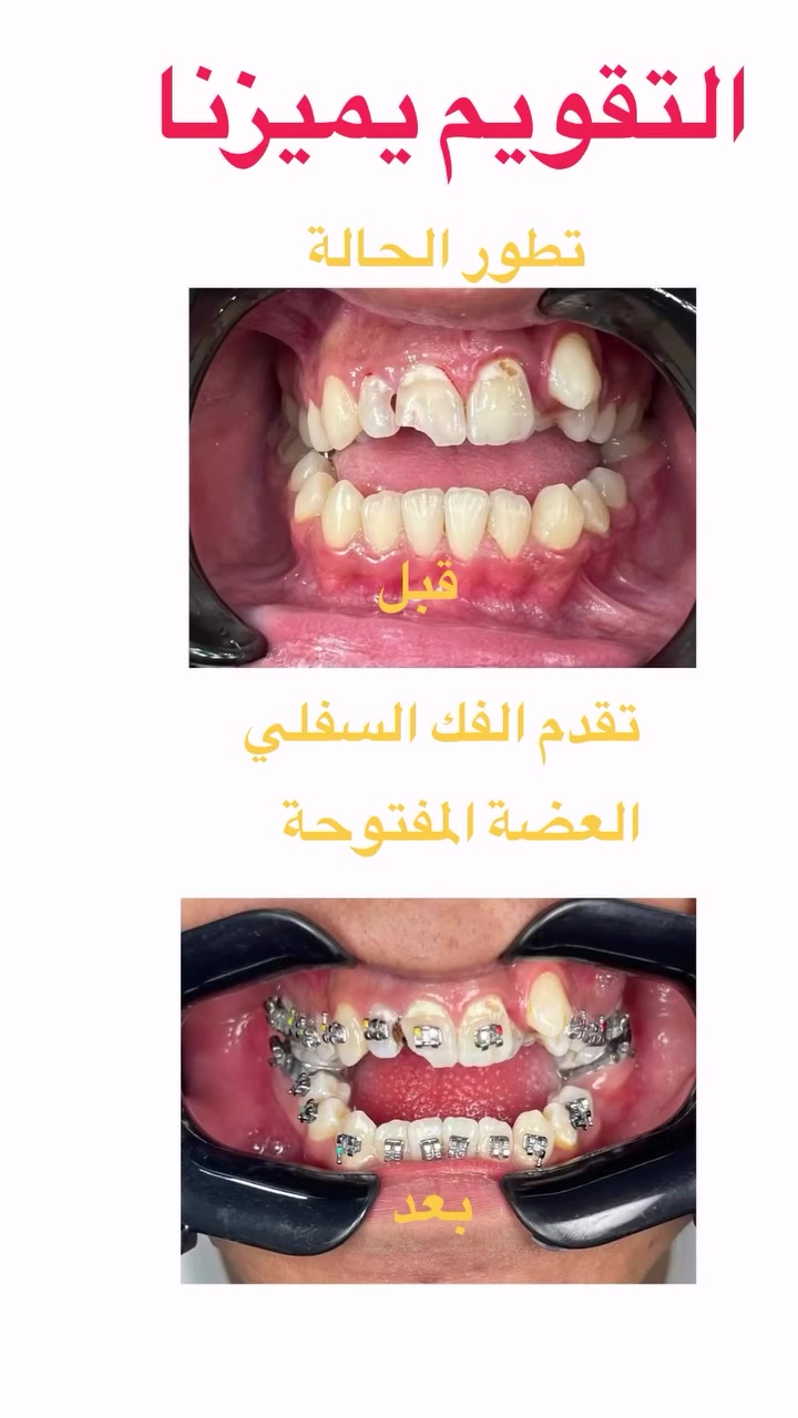 التقويم يميزنا احد اعقد و اصعب الحالات تقدم الفك السفلي و انحسار العلوي العضة المفتوحة عند اطباق الاسنان يعاني من مظهر غير متناسق و عدم مضغ و تقطيع الطعام عدم لفظ الحروف الكلمات انحسار الاسنان العلوية و تضييق الأنف التنفس الفموي اثناء النوم… مستمرون حتى نهاية العلاج … علاج جميع الحالات الصعبة و المعقدة نتائج مضمونة اسعار مناسبة الدقة  العلمية في العمل توفير بيئة علاجية مناسبة… دكتور غزوان مزهر بغداد الكرخ نفق الشرطة بداية شارع الاطباء عيادة لوركا فوق صيدلية كنز النفق متوفر واتس *********** #تقويم_الأسنان_والفكين #تقويمالأسنان #تقويم_الأسنان_بأنواعه #تقويم_الشفاف_للأسنان #تقويم_الأسنان_قبل_وبعد  @تقويم_الاسنان @حشوات_الاسنان @العضة_المعكوسة @تقدم_الفك_السفلي @العضة_المفتوحة
