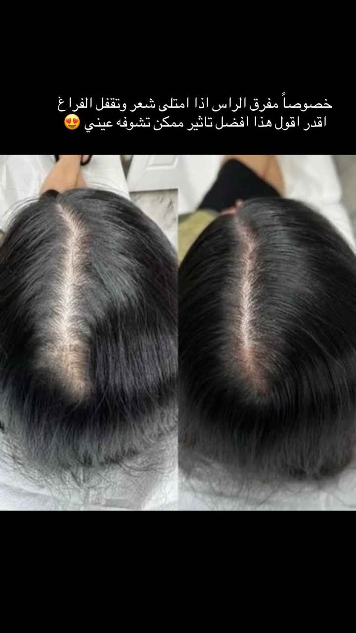 صابونة سيفن جرين (Seven Green Shampoo Bar):
الوصف: قالب شامبو صلب مصنوع من خلاصة الأعشاب الصينية التقليدية مثل Cacumen Biotae وIsatis Indigotica.
الفوائد: تنظيف فروة الرأس بعمق وإزالة الدهون والقشرة، تقوية بصيلات الشعر، والمساعدة في تكثيف الشعر كبديل طبيعي لزراعة الشعر.
المميزات: خالية من الكبريتات والسيليكون والمواد الكيميائية الضارة دهل اوران, واسط


**إذا كنت صاحب هذا الإعلان وتريد حذفه لأي سبب، رجاءا أرسل رسالة إلى الدعم الفني**