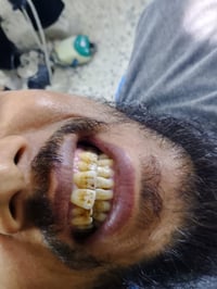 تنظيف الاسنان من التكلسات vip ابتسامتك صحيه وبجلسه وحده   الموقع/ حي 1...
