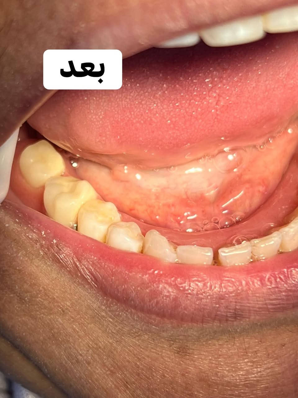 السلام عليكم 
رجعت انفتحت الحجوزات عند الدكتورة تبارك المشعان 
لتعويض الاسنان المفقوده وبشكل مجاني 100‎%‎ 
وكذلك الحشوات وقلع الاسنان التآلفه وتعويضها 
علقو تم او راسلوني خاص على الماسنجر او على الرقم التالي *********** على الواتساب
علماً الحجز ينغلق يوم الجمعة مساءاً
