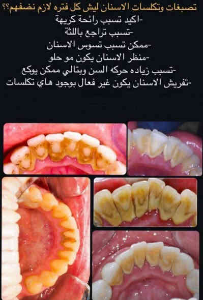 تعلن عيادات  اللصفوه التخصصية لطب الأسنان عن بدء استقبالها للمراجعين وتقديم الخدمات الطبية
مجاناً بإشراف أطباء مختصين للحالات التالية:

حشوات ضوئية دائمة للأسنان (مجاناً)

تنظيف وازالة  تكلسات الاسنان ( مجانًا )

قلع الأسنان التالفه وبقايا الجذور (مجاناً)

تعويض الأسنان المفقودة بقالب أسنان متحرك

حي النقيب/ شارع النهر

للحجز والاستفسار *********** واتساب
***********
