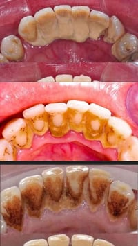 تنضيف اسنان • كلية طب الاسنان • الرمادي