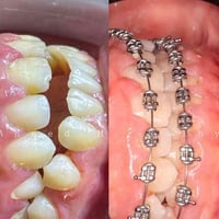 تقويم أسنان • أقساط • ناحية الشوره