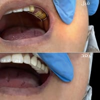 تلبيسات زيركون • تجميل أسنان • واسط بدرة