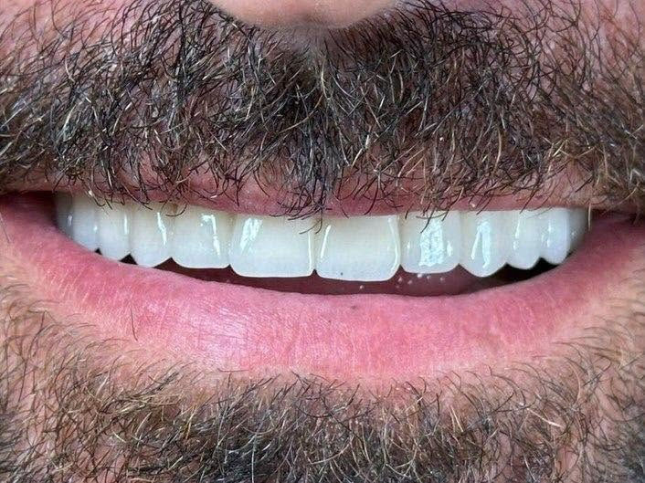 زراعة الأسنان هي الحل الأمثل لاستعادة ابتسامتك

الطبيعية بثقة وأمان ✨
مع أحدث التقنيات الطبية، نوفر لك أسنان ثابتة وقوية تشبه تماماً أسنانك الأصلية من حيث الشكل والوظيفة.
استعد راحتك أثناء الأكل والكلام، وودّع الفراغات المزعجة بابتسامة متكاملة تدوم لسنوات🦷✨
احجز موعدك الآن وابدأ رحلتك نحو ابتسامة أجمل!

متواجدين طيلة ايام الاسبوع
  نستقبلكم بكل حُب♥️
العنوان : الديوانية/ تحت الجسر المعلق / بناية فندق الديوانية سابقًا / مقابل المحافظة

للحجز والاستفسار 
***********
***********⁩
