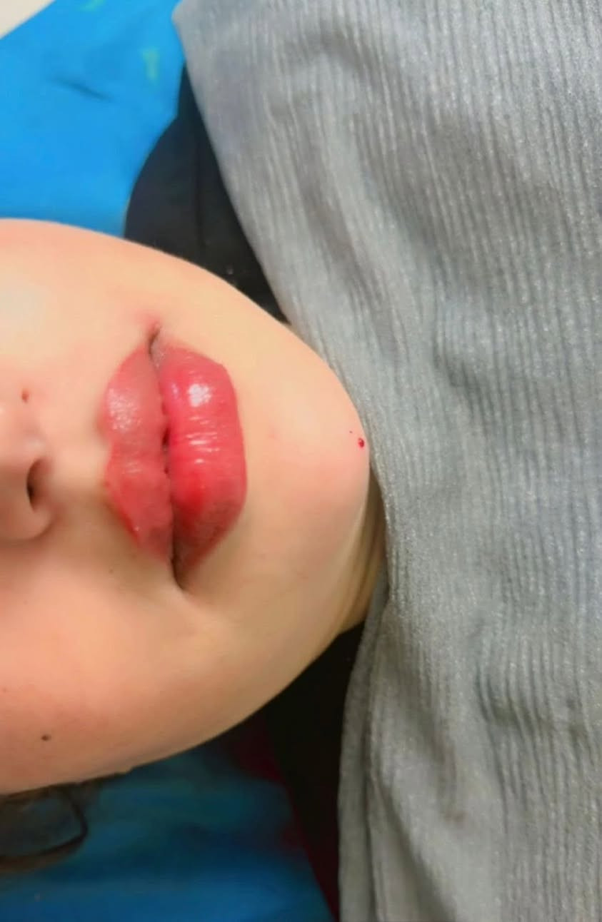 حقن فلر الشفاه👄 بطريقة ناعمة لمراجعتي الجميلة 
 
الهدف من الحقن💉إبراز الجمال الطبيعي وليس تغييره ❤️‍🔥

ميرو للَتجْميل واللَيزَرْ
للحجز والاستفسار :***********
ميرو للَتجْميل واللَيزَرْ
بنات تعير يجنن
@إشارة
