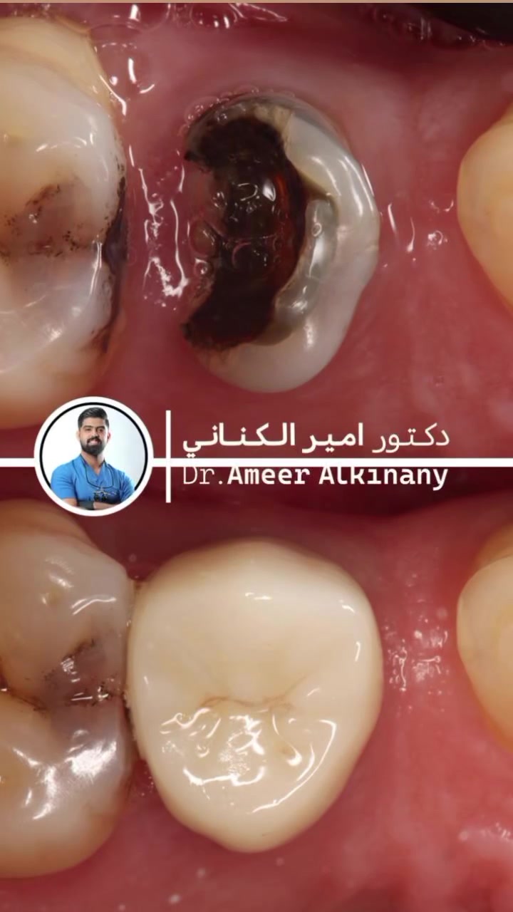 الشغل ✅ بالمكان ✅
#إعادة تأهيل سن كامل بأفضل المواد وأحدث الأجهزة 👌
للحجز والاستفسار مراسلة الصفحة او على الارقام:
***********
***********
📌 الحمزة الشرقي / شارع الاطباء/ قرب عيادة دكتور مهند الميالي مجاور صيدلية الايمن
