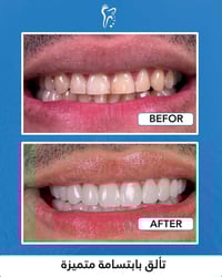 تبييض أسنان • بغداد المدائن • مجمع البيت الاصفر