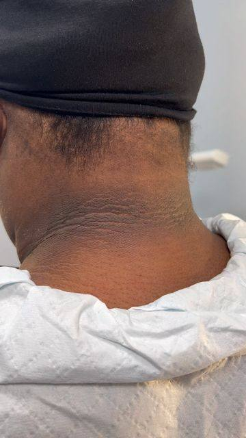 ✅⚡مقاومة الإنسولين تعني أنّ جسمك ما يستجيب بصورة طبيعية لهرمون الإنسولين، فيضطر البنكرياس يفرز إنسولين أكثر حتى يحافظ على مستوى السكر طبيعي. ومع الوقت ممكن يرتفع السكر ويصير عندك سكر من النوع الثاني إذا ما تعالجت الحالة.

⚡أعراض مقاومة الإنسولين

مو شرط تظهر أعراض واضحة، بس أكثر العلامات شيوعاً:

زيادة الوزن خاصة في البطن

صعوبة إنقاص الوزن

الشعور بالجوع بسرعة

تعب وخمول

اسوداد الجلد حول الرقبة أو الإبطين (Acanthosis nigricans)

ارتفاع ضغط أو دهون الدم

⚡أسباب مقاومة الإنسولين

السمنة وخصوصاً سمنة البطن

قلة الحركة

كثرة تناول السكريات والكربوهيدرات

الضغوط النفسية والسهر

التاريخ العائلي للسكري

تكيس المبايض عند النساء

⚡⚡تحاليل تكشف مقاومة الإنسولين

حتى نعرف إذا عندك مقاومة إنسولين، عادة نعمل:

1. HOMA-IR (الأدق)

2. Insulin fasting إنسولين صائم

3. Fasting blood sugar سكر صائم

4. HbA1c

5. Lipid profile لفحص الدهون

🔬 مختبر الصمد الطبي

🌞 مواعيد الدوام:
نستقبلكم صباحًا ومساءً لخدمتكم في أي وقت يناسبكم 

✅خدمة السحب المنزلي مجانية 

📍 العنوان: الدورة - شارع ٦٠ - قرب اسواق توشه 
📞 للاستفسار: ‏‪***********
