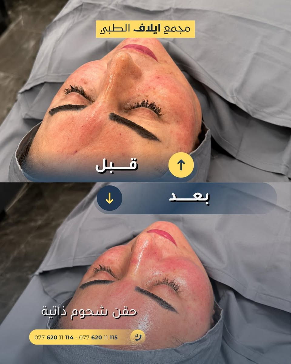 حالة اليوم: حقن الشحوم الذاتية ✨

باستخدام الدهون المستخلصة من الجسم، نكدر نمنح بشرتج امتلاء متناسق ونستعيد حيوية وجهج بشكل طبيعي وآمن، مع نتائج تعزز الملامح وتحافظ على جمال وجهج بدون مبالغة 🌸🌸

اذا حابة تحجزين موعدج راسلينا وتدللين 💞

العنوان/ خانقين - شارع البريد- قرب مول التفاح الاخضر 

للحجز والاستفسار على الارقام التالية / 
***********- ***********

#تجميل #مجمع ايلاف الطبي #مجمعات-طبية #حقن #حقن شحوم ذاتية#خانقين
